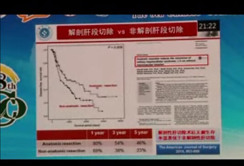 [CCO2014]郑树森院士：肝癌外科治疗